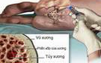 Điều trị vi&#234;m xương tủy nhiễm khuẩn